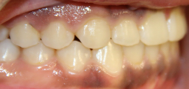 After patient photo: Side view of mouth with corrected Underbite