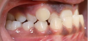 Before patient photo: Side view of mouth with Underbite issue