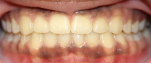 After patient photo: Orthodontic bite Corrected