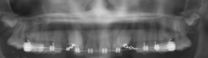 Digital patient radiograph: An in progress image, showing exposed impacted teeth