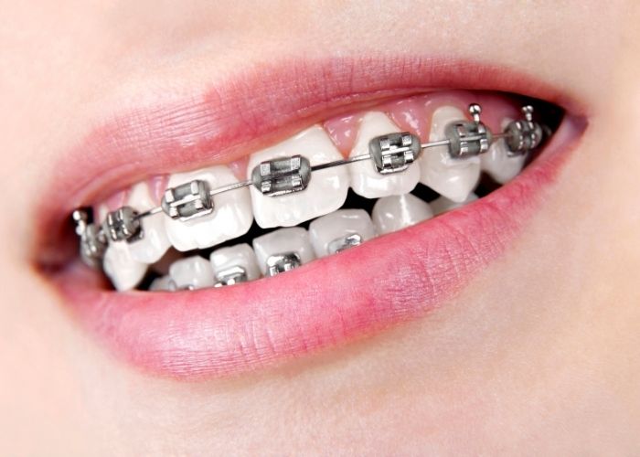 Braces for Kids