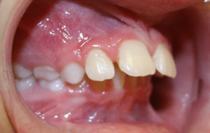 Before patient photo: Orthodontic Overjet condition